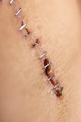 Staples surgical incision healing scar transplant operation closeup