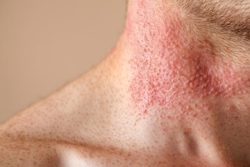 Fototapeta premium Close-Up of Red and Irritated Neck with Skin Rash and Bumps