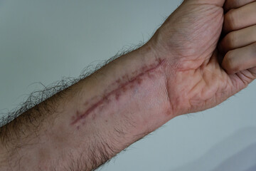 hand injuried with a scar