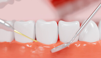 A dental procedure is being performed on a patient. A dentist is using a dental scaler and a mirror to clean a tooth. The tooth is surrounded by inflamed gums. 3d render.