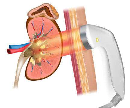 Extracorporeal shock wave lithotripsy or ESWL. Treatment kidney stones. Wave lithotripsy therapy.