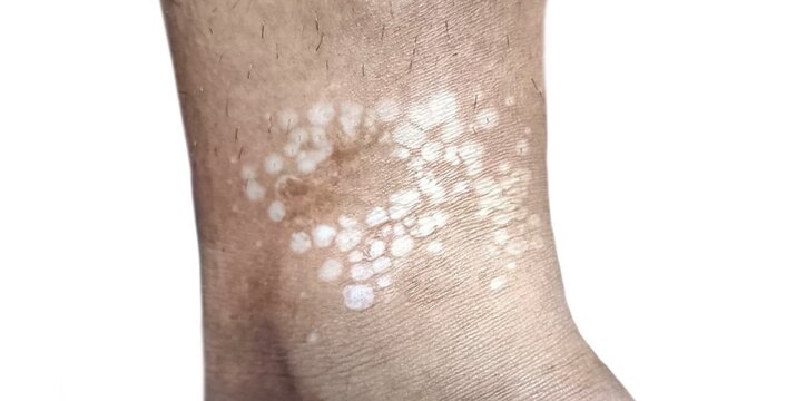 A leg with white patches characteristic of tinea versicolor, a fungal skin infection.