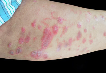 A raised, red, target like rash on the skin or mucous membranes characteristic of erythema multiforme