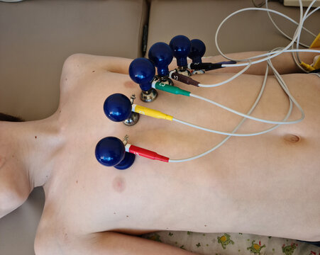 A patient undergoing an electrocardiogram test with electrodes attached to the chest
