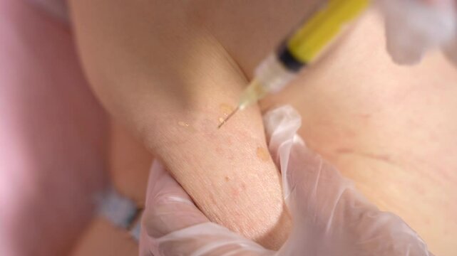Vertical shot of lipolytics injection under the skin with a needle. close-up injections in the stomach. weight loss procedure. anti-aging procedures. doctor's hands in gloves. beauty.cosmetology