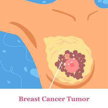 breast cancer tumor found in women body anatomy flat illustration