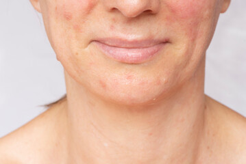 Obraz premium Allergic symptoms on the skin of the face of women. The problem, prevention and care for healthy clean skin.