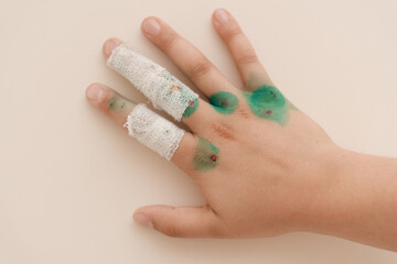 Close up of hand with bandages and treated areas after wart removal or other cosmetic surgery