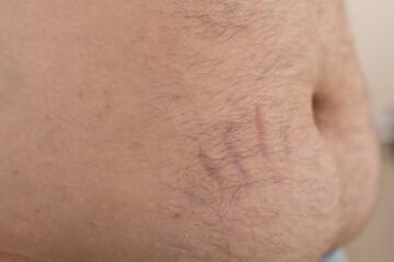 Fototapeta premium A close-up of a human belly with stretch marks and visible body hair.