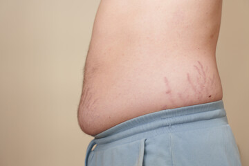 Close-up of a human belly in profile with stretch marks