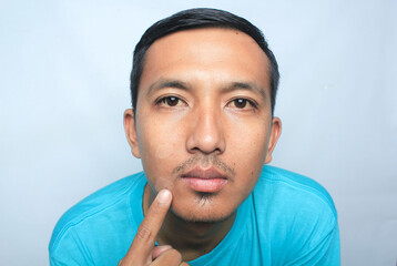 Close up of young Asian man face pointing to a white spot near the lips called Pityriasis alba.