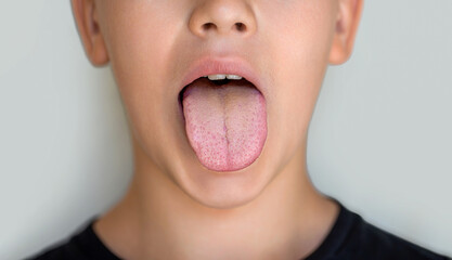 White coating on tongue child. Oral thrush. Boy showing her tongue. Child puts out tongue -...