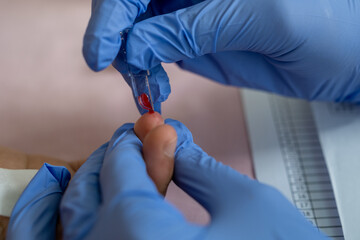 Medical professional wearing blue gloves collecting blood sample from fingertip using clear slide, highlighting cleanliness, precision and accuracy in healthcare procedures