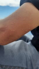 braço de turista com picadas de mosquito