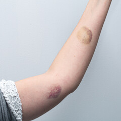 Woman showing large bruises on arm