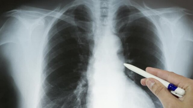 Doctor radiologically analyzing the chest with x-ray
Hand of a doctor analyzing and pointing with a pen to the affected area