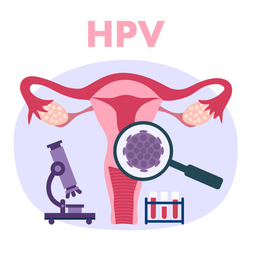 HPV (Human Papillomavirus) Cervical cancer screening and treatment, PAP test, viruses some strains infect genitals and can cause cervical cancer. women health concept.