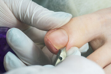 Podiatrist using pedicure clippers trims dry skin around a toenail