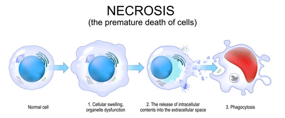Necrosis. Uncontrolled cell death.