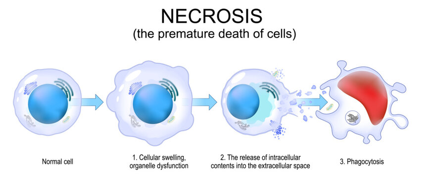 Necrosis. Uncontrolled cell death.