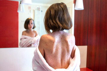 Natural vaccination. Contagious disease. Sick child with chickenpox. Varicella virus or Chickenpox...