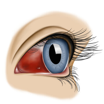 Eye sub conjunctival bleeding hemorrhage