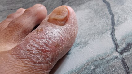 the skin of the big toe is cracked and watery. eczema disease