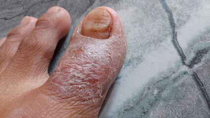 Fototapeta premium the skin of the big toe is cracked and watery. eczema disease