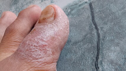 the skin of the big toe is cracked and watery. eczema disease