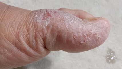 Fototapeta premium the skin of the big toe is cracked and watery. eczema disease