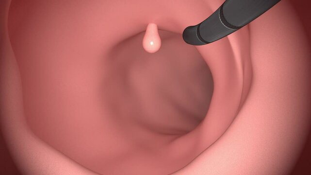 Animation Precancerous Polyp In The Colon Found And Removed During Colonoscopy Procedure For Analysis. macro