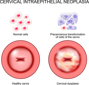 Cervical intraepithelial neoplasia. Cervical dysplasia. CIN