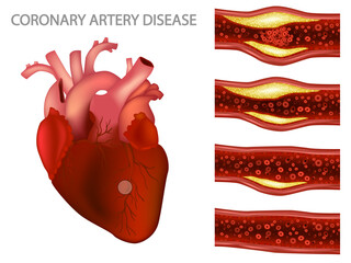 Coronary artery disease and Ischemic heart disease. Atherosclerosis in a coronary artery. Cardiovascular diseases. Reduction of blood flow to the cardiac muscle.