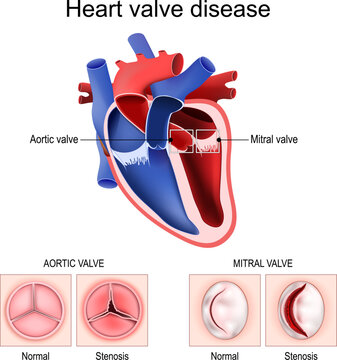 Heart valve disease. Healthy valve and Stenosis.