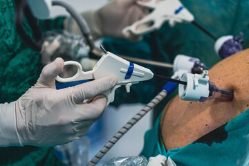 gastric sleeve surgery performing by surgeon	