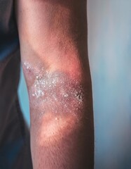 Psoriasis Patch on Elbow