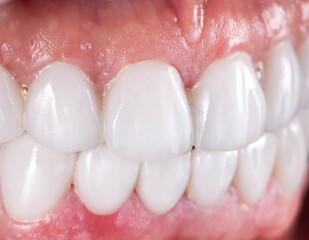 zirconium ceramic crowns and veneers