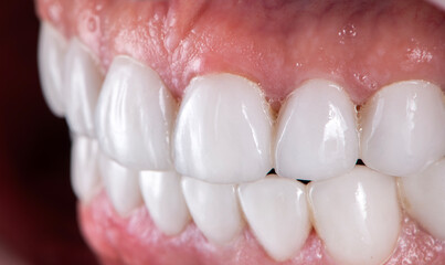 zirconium ceramic crowns and veneers
