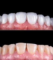 zirconium ceramic crowns and veneers