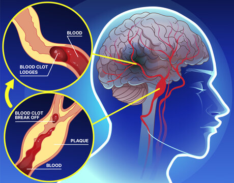 Ischemic stroke. Brain's blood vessels become narrowed or blocked. Healthcare illustration. Healthcare infographic. Vector illustration. 