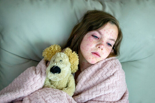 Natural vaccination. Contagious disease. Sick child with chickenpox. Varicella virus or Chickenpox bubble rash on child body and face. High quality photo. 