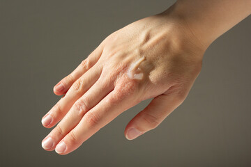 Close-up of a woman applying petroleum jelly to eczema on her hands.