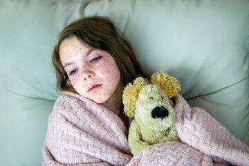 Natural vaccination. Contagious disease. Sick child with chickenpox. Varicella virus or Chickenpox...