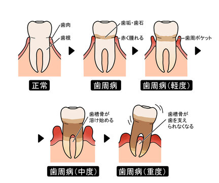 歯周病の進行（文字あり）