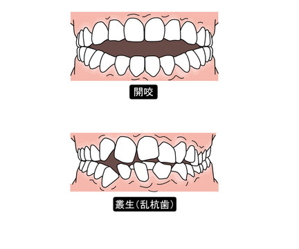 歯列矯正が必要な歯並びPart2