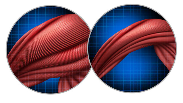 Cancer Cachexia as appetite reduction and not eating enough due to disease losing muscle and fat resulting in weight loss or muscles atrophy or Muscular dystrophy.