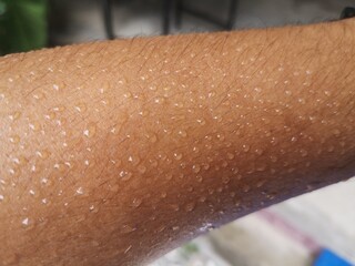 Hyperhidrosis, Excessive sweating, sweat droplets on the skin, sweating because of the hot weather.