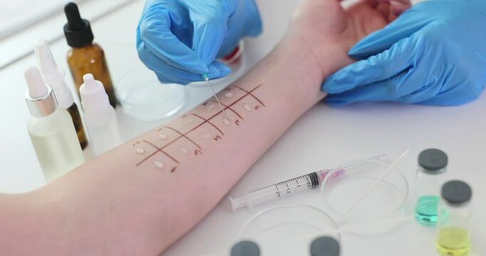 Demonstration of skin allergy testing procedure in clinic