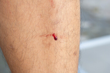 Blood coming out of a man's leg wound from an accident.