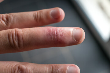 Mallet finger healing after splint removal from middle finger following joint trauma